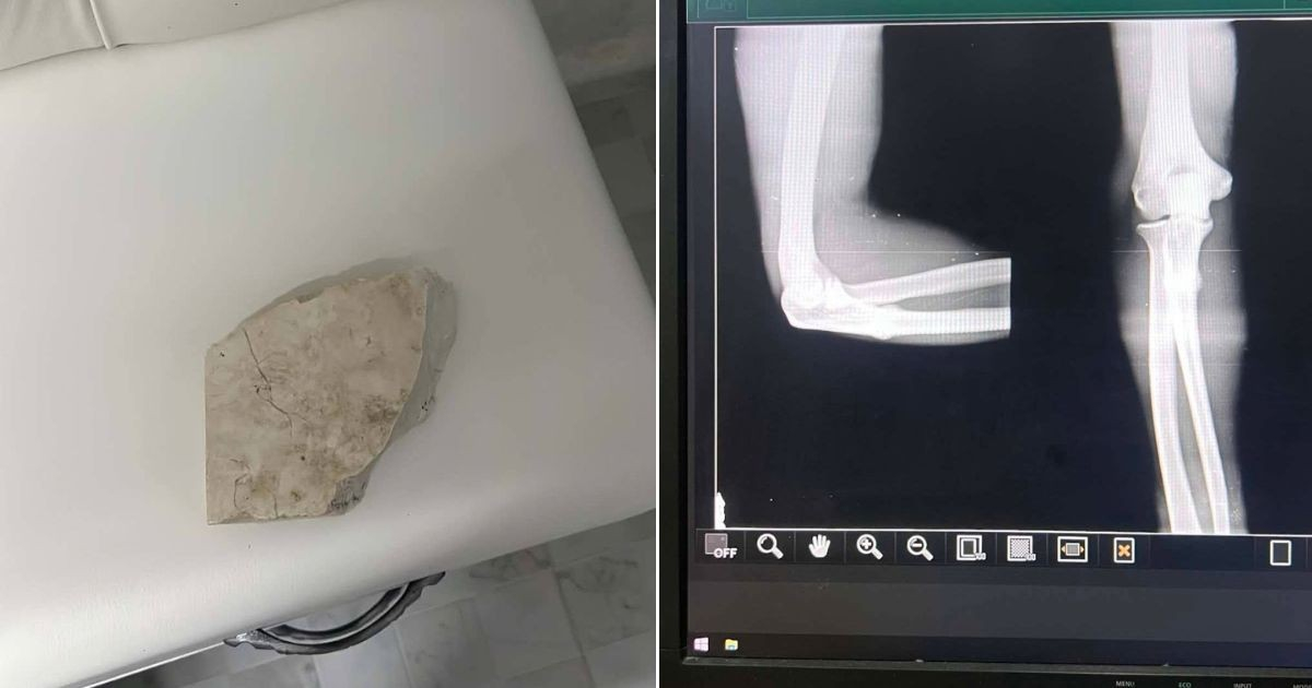 Le fracturan un brazo de una pedrada para robarle la moto en Camagüey